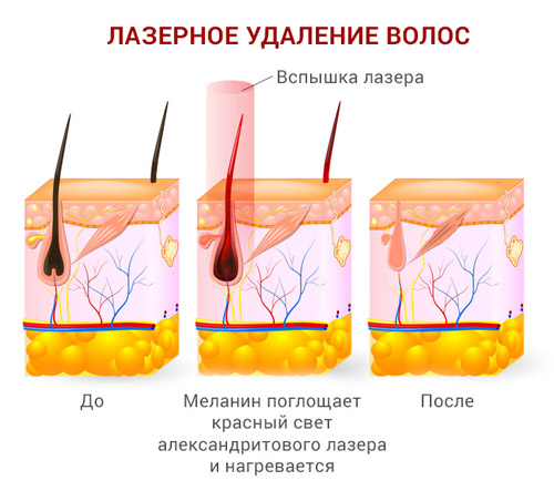 Scheme laser hair removal.jpg